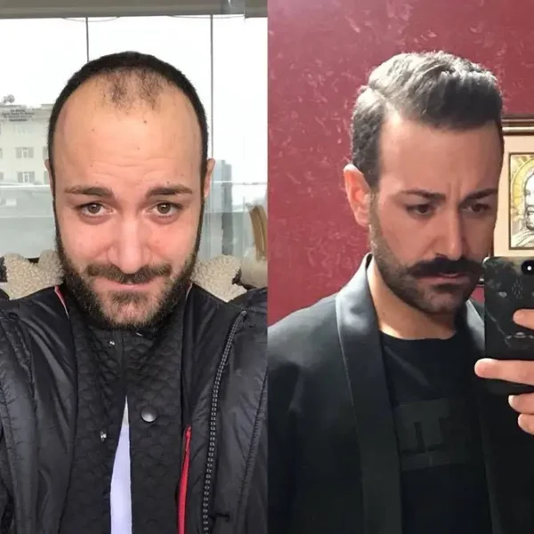 HLW | Men's Hair Replacement Units with Natural Lace Front and Skin Perimeter - Image 6