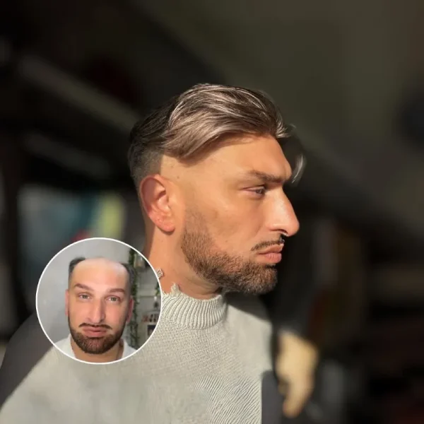 STSV | 0.06mm Ultra Thin Skin V-looped Men’s Hairpieces - Image 5